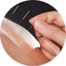 Acupuncture