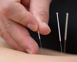 Acupuncture Needles